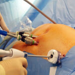 When is Laparoscopic Myomectomy Recommended: Everything You Need to Know!